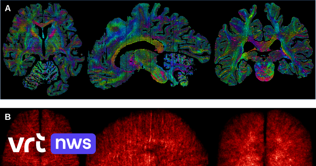 Most detailed brain images ever: Scientists combine MRI scans with microscope