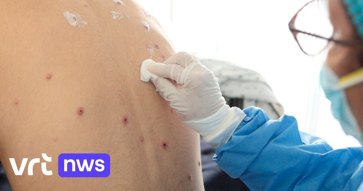 コンゴでサル痘の症例が急増、「しかし世界的大流行の差し迫った脅威ではない」