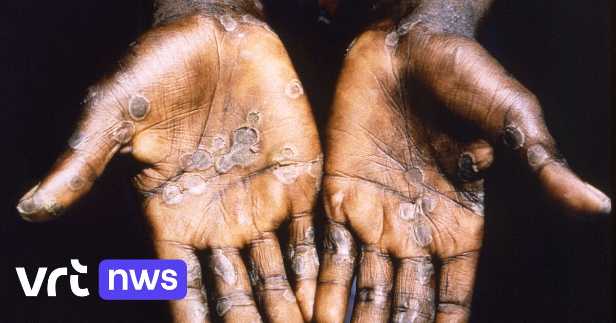 WHO calls an emergency committee in the international fight against smallpox