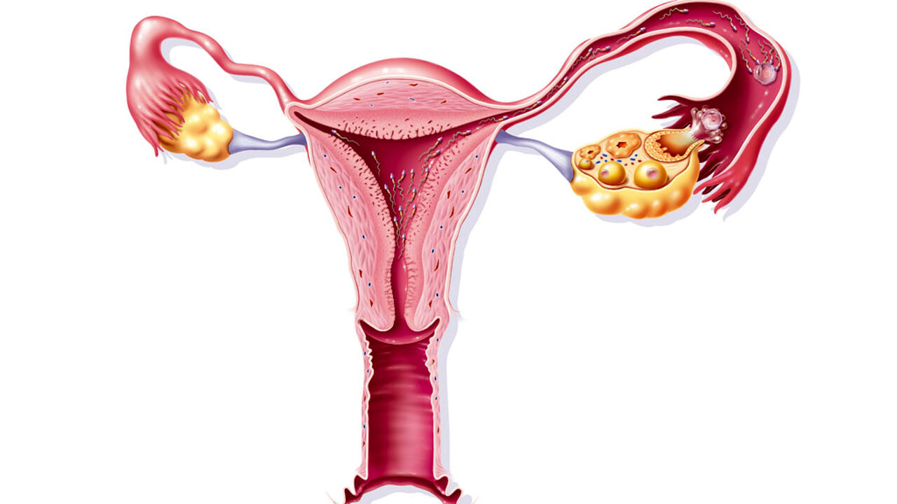 Сперматозоиды в матке со спиралью