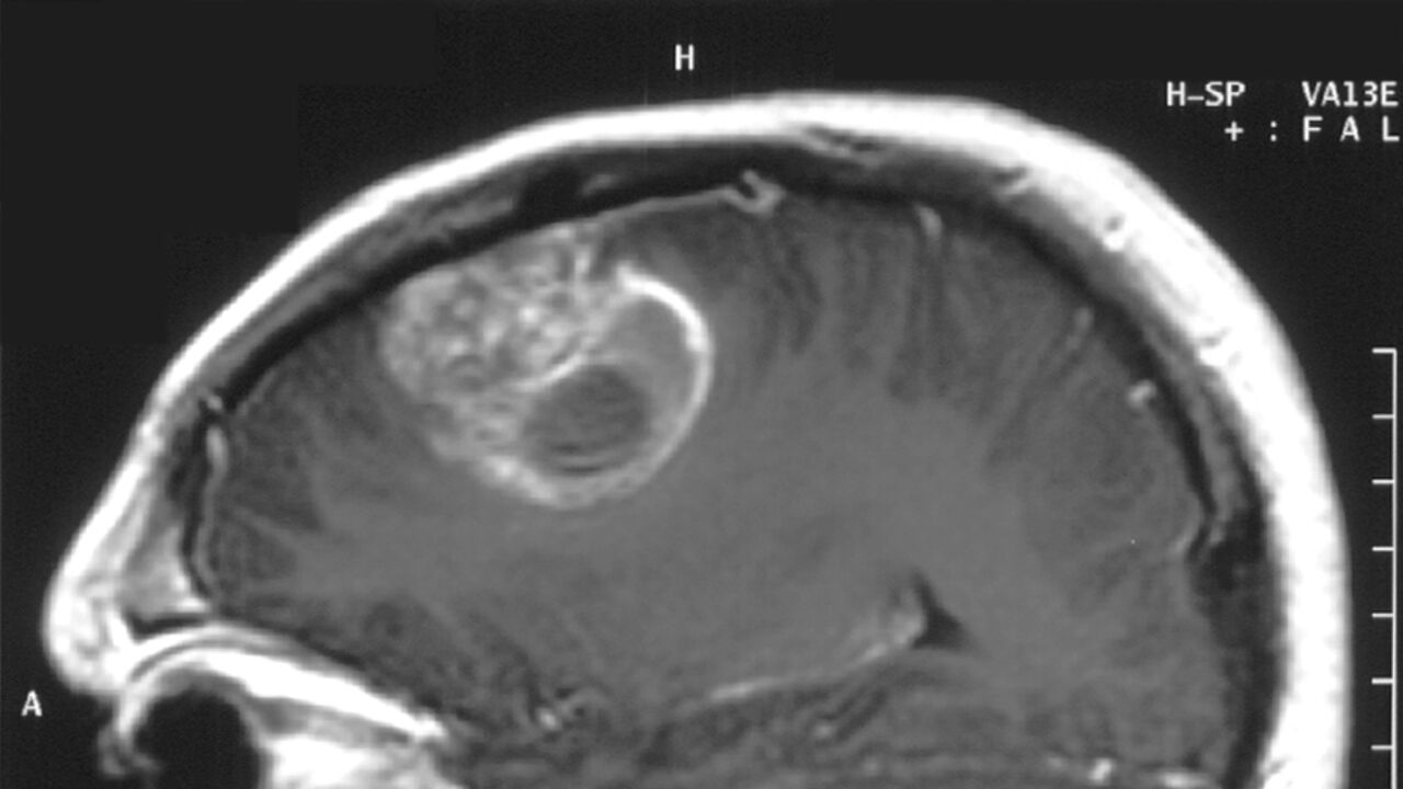 Een MRI van een glioblastoom. 