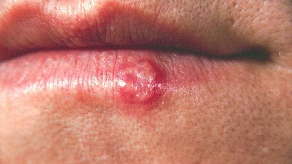 Een veel voorkomend symptoom van HSV-1 is koortslip, blaasjes op de lippen. 